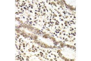 Immunohistochemistry of paraffin-embedded human gastric cancer using LMNB2 Antibody (ABIN5973877) at dilution of 1/200 (40x lens). (Lamin B2 抗体)