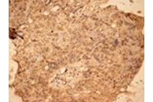 Immunohistochemistry analysis of human lung cancer tissue with PKC pAb. (PKC 抗体)