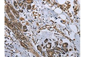 The image on the left is immunohistochemistry of paraffin-embedded Human breast cancer tissue using ABIN7129587(GDF3 Antibody) at dilution 1/25, on the right is treated with fusion protein. (GDF3 抗体)