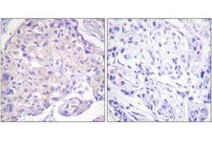 Immunohistochemistry analysis of paraffin-embedded human breast carcinoma, using PAK1 (Phospho-Thr212) Antibody. (PAK1 抗体  (pThr212))