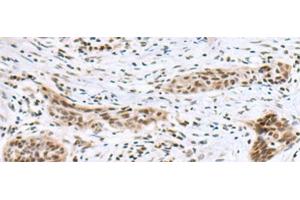 Immunohistochemistry of paraffin-embedded Human esophagus cancer tissue using INSM1 Polyclonal Antibody at dilution of 1:50(x200)