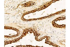 ABIN7094814 and ABIN7098865 at 1/100 staining Human colorectal cancer by IHC-P.