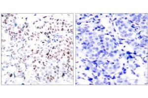 Immunohistochemical analysis of paraffin-embedded human breast carcinoma tissue using Myc(Phospho-Thr358) Antibody(left) or the same antibody preincubated with blocking peptide(right). (c-MYC 抗体  (pThr358))