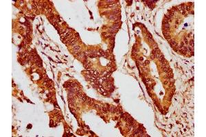 IHC image of nme1HU diluted at 1:10 and staining in paraffin-embedded human colon cancer performed on a Leica BondTM system. (Histone H2B 抗体  (AA 9-20))