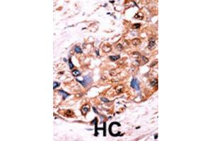 Immunohistochemistry (IHC) image for anti-V-Yes-1 Yamaguchi Sarcoma Viral Oncogene Homolog 1 (YES1) (pTyr530), (pTyr537) antibody (ABIN2970974) (YES1 抗体  (pTyr530, pTyr537))