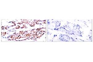 Immunohistochemical analysis of paraffin-embedded human breast carcinoma tissue using JunB (phospho- Ser79) antibody (E011026). (JunB 抗体  (pSer79))