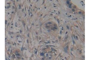 Detection of TTK in Human Pancreatic cancer Tissue using Polyclonal Antibody to TTK Protein Kinase (TTK) (Mps1 抗体  (AA 532-786))