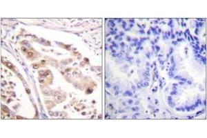 Immunohistochemistry analysis of paraffin-embedded human lung carcinoma tissue, using RFA2 (Ab-21) Antibody. (RPA2 抗体  (AA 10-59))