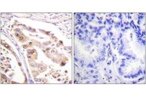 Immunohistochemistry analysis of paraffin-embedded human lung carcinoma tissue, using RFA2 (Ab-21) Antibody. (RPA2 抗体  (AA 10-59))