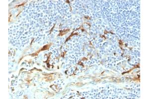 Formalin-fixed, paraffin-embedded human endometrial carcinoma stained with Biotin-conjugated Mesothelin Mouse Monoclonal Antibody (MSLN/2131). (Mesothelin 抗体  (AA 273-407) (Biotin))