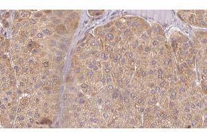 ABIN6277526 at 1/100 staining Human Melanoma tissue by IHC-P. (BPI 抗体  (Internal Region))