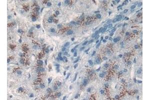 Detection of TP53TG5 in Human Liver cancer Tissue using Polyclonal Antibody to TP53 Target Gene 5 (TP53TG5) (TP53TG5 抗体  (AA 190-262))