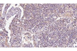 ABIN6273167 at 1/100 staining Human lymph cancer tissue by IHC-P. (SRP14 抗体  (Internal Region))