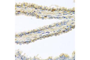 Immunohistochemistry of paraffin-embedded human prostate using GPLD1 antibody (ABIN5973975) at dilution of 1/100 (40x lens). (GPLD1 抗体)