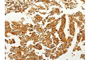 The image on the left is immunohistochemistry of paraffin-embedded Human gastric cancer tissue using ABIN7190727(FZD6 Antibody) at dilution 1/60, on the right is treated with synthetic peptide. (FZD6 抗体)