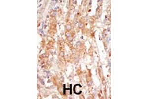 Formalin-fixed and paraffin-embedded human cancer tissue reacted with the primary antibody, which was peroxidase-conjugated to the secondary antibody, followed by DAB staining. (MAP3K6 抗体  (C-Term))