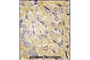 Formalin-fixed and paraffin-embedded human prostata carcinoma tissue reacted with FZD1 antibody (Center) (ABIN389236 and ABIN2839386) , which was peroxidase-conjugated to the secondary antibody, followed by DAB staining. (FZD1 抗体  (AA 367-396))