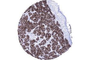 Strong membranous CD56 staining in a neuroendocrine tumor of the lung (Recombinant CD56 抗体)