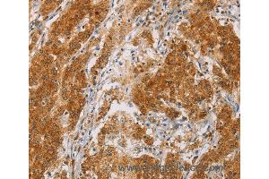 Immunohistochemistry of Human colon cancer using CENPE Polyclonal Antibody at dilution of 1:50 (CENPE 抗体)