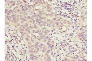 Immunohistochemistry of paraffin-embedded human bladder cancer using ABIN7155761 at dilution of 1:100 (HOXD1 抗体  (AA 1-240))