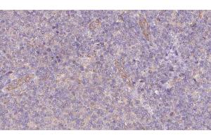 ABIN6273074 at 1/100 staining Human lymph cancer tissue by IHC-P. (SNAPIN 抗体  (N-Term))