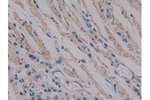 Detection of PKIb in Human Stomach cancer Tissue using Polyclonal Antibody to Protein Kinase Inhibitor Beta (PKIb) (PKIB 抗体  (AA 8-76))
