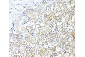 Immunohistochemistry of paraffin-embedded Human liver cancer using ASL Polyclonal Antibody at dilution of 1:100 (40x lens). (ASL 抗体)