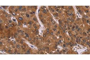 Immunohistochemistry of paraffin-embedded Human liver cancer using PPIB Polyclonal Antibody at dilution of 1:45 (PPIB 抗体)