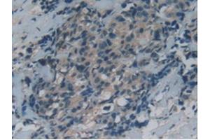 IHC-P analysis of Human Thyroid Cancer Tissue, with DAB staining. (GAS6 抗体  (AA 136-311))
