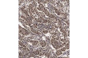 Immunohistochemical analysis of (ABIN654398 and ABIN2844139) on paraffin-embedded Human breast carcinoma tissue. (SCXA 抗体  (C-Term))
