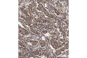 Immunohistochemical analysis of (ABIN654398 and ABIN2844139) on paraffin-embedded Human breast carcinoma tissue. (SCXA 抗体  (C-Term))