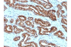 Formalin-fixed, paraffin-embedded human prostate carcinoma (10X) stained with AMACR / p504S Rabbit Monoclonal Antibody (13H4) (AMACR 抗体)