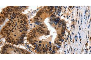 Immunohistochemistry of paraffin-embedded Human colon cancer using 14-3-3 epsilon Polyclonal Antibody at dilution of 1:100 (YWHAE 抗体)