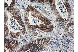 Immunohistochemical staining of paraffin-embedded Adenocarcinoma of Human colon tissue using anti-SULT1C2 mouse monoclonal antibody. (SULT1C2 抗体)