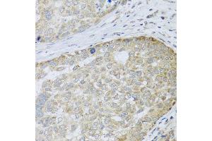 Immunohistochemistry of paraffin-embedded human liver cancer using ANAPC10 antibody at dilution of 1:100 (x40 lens). (ANAPC10 抗体)