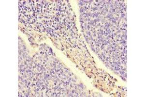 Immunohistochemistry of paraffin-embedded human cervical cancer using ABIN7169007 at dilution of 1:100 (ARAF 抗体  (AA 160-310))