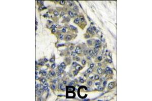 Formalin-fixed and paraffin-embedded human breast carcinoma reacted with EIF4B polyclonal antibody  , which was peroxidase-conjugated to the secondary antibody, followed by DAB staining. (EIF4B 抗体  (Internal Region))