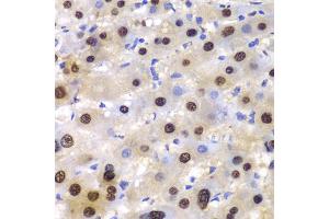 Immunohistochemistry of paraffin-embedded human liver injury using ETS1 antibody (ABIN5970774) at dilution of 1/100 (40x lens). (ETS1 抗体)
