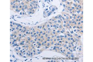 Immunohistochemistry of Human lung cancer using HOXA6 Polyclonal Antibody at dilution of 1:60 (HOXA6 抗体)