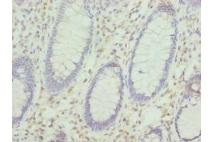 Immunohistochemistry of paraffin-embedded human colon cancer using ABIN7157478 at dilution of 1:100 (KHDRBS2 抗体  (AA 1-349))