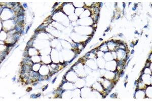 Immunohistochemistry of paraffin-embedded Human colon using HK2 Polyclonal Antibody at dilution of 1:200 (40x lens). (Hexokinase 2 抗体)