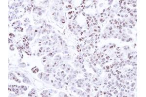 IHC-P Image Immunohistochemical analysis of paraffin-embedded OVCAR3 xenograft, using CAMK1D, antibody at 1:500 dilution. (CAMK1D 抗体)