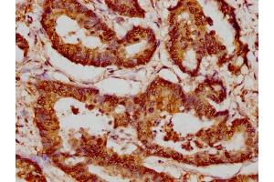 IHC image of nacHU diluted at 1:20 and staining in paraffin-embedded human colon cancer performed on a Leica BondTM system. (HIST1H4A 抗体  (AA 74-85))