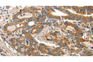 Immunohistochemistry of paraffin-embedded Human gasrtic cancer tissue using ANGPTL1 Polyclonal Antibody at dilution 1:40 (ANGPTL1 抗体)