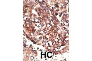 Formalin-fixed and paraffin-embedded human hepatocellular carcinoma tissue reacted with MMP13 polyclonal antibody , which was peroxidase-conjugated to the secondary antibody, followed by AEC staining. (MMP13 抗体  (C-Term))