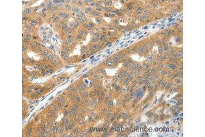 Immunohistochemistry of Human gastric cancer using SCN9A Polyclonal Antibody at dilution of 1:40 (SCN9A 抗体)