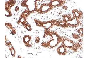 Formalin-fixed, paraffin-embedded human Breast Carcinoma stained with Calpastatin Mouse Monoclonal Antibody (CAST/1550). (Calpastatin 抗体)