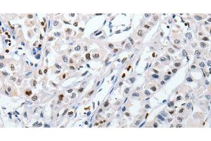 Immunohistochemistry of paraffin-embedded Human lung cancer tissue using HSPA1A Polyclonal Antibody at dilution 1:60 (HSP70 1A 抗体)