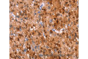 Immunohistochemistry of Human liver cancer using GH1 Polyclonal Antibody at dilution of 1:40 (Growth Hormone 1 抗体)