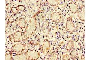 Immunohistochemistry of paraffin-embedded human gastric cancer using ABIN7153609 at dilution of 1:100 (GJB2 抗体  (AA 99-131))